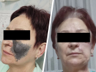 Гигантскую черную родинку на лице пенсионерки удалил хирург в Ставрополе