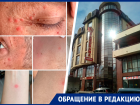 «Отдых превратился в бытовой кошмар»: семья пожаловалась на клопов в гостинице Кисловодска