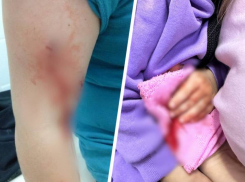 Фотографии покусанных собаками детей в Минводах шокировали ставропольцев 