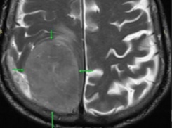 В голове 85-летнего пенсионера в Пятигорске обнаружили опухоль размером с лимон