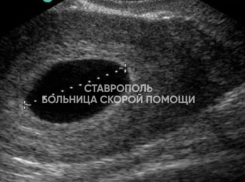 Контрацептивы не сработали: реальная история пациентки из Ставрополя