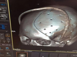 Уникальную операцию по установке индивидуального импланта в череп провели в Ставрополе