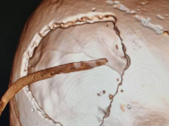 Не разбудили утром: история 30-летнего парня, выжившего после падения и сложнейшей операции на мозге в Ессентуках