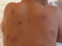 Сразу 16 укусов на теле ребенка насчитала мама после его посещения детсада в Минводах