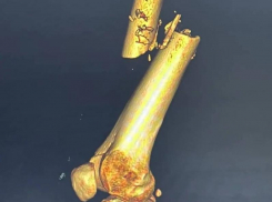 После тяжелого ДТП в Ставрополе врачи спасли мужчину с ампутированной ногой