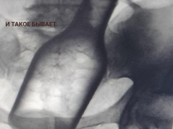 Монета, проволока, бутылка: что извлекали из ставропольских пациентов в 2025 году