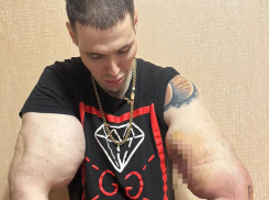 Блогер Руки Базуки из Пятигорска показал, как выглядит на 5 день после серьезной операции 