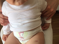 8-месячной малышке пришлось делать операцию после прививки от столбняка в Ставрополе 