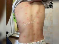  Сыпь появилась у ребенка после купания на озере в Ессентуках 