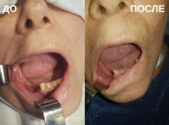 Врачи в Ставрополе вылечили остеонекроз челюсти у онкобольного