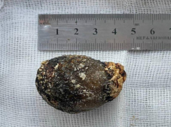 Огромный булыжник нашли пятигорские хирурги в желчном пузыре пациентки