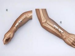 Редкая операция в Ставрополе: ребенку со сложной болезнью костей вернули подвижность руки