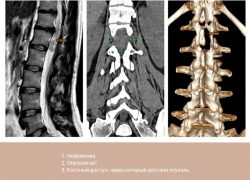 Опухоль из позвоночника через крошечный разрез удалили пациентке нейрохирурги Пятигорска