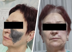 Гигантскую черную родинку на лице пенсионерки удалил хирург в Ставрополе