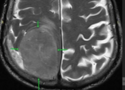 В голове 85-летнего пенсионера в Пятигорске обнаружили опухоль размером с лимон