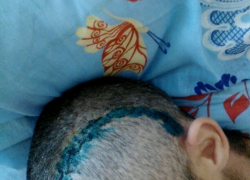 Парень остался без части черепа после избиения около бильярдного клуба на Ставрополье