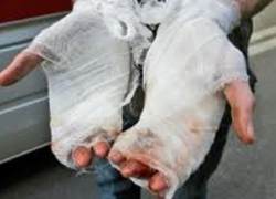 Ожоги тела получил житель Ставрополья из-за пожара в частном доме