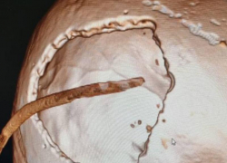 Не разбудили утром: история 30-летнего парня, выжившего после падения и сложнейшей операции на мозге в Ессентуках