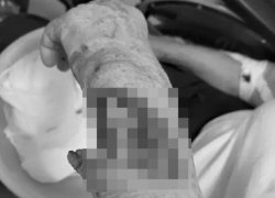 Порвала руку: 83-летняя ставропольчанка попала в больницу из-за скользкой лестницы 