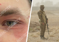 «Тут и с болезнями похуже служат»: в военную часть под Ставрополем попал парень с тяжелым дерматитом