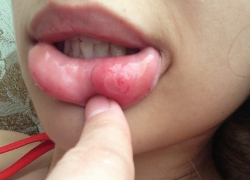 Пять женщин стали жертвами «уколов красоты» доморощенного косметолога в Ставрополе 