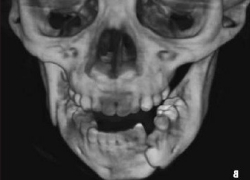 Задетое боковое стекло авто обернулось сломанной челюстью для водителя на Ставрополье