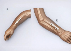 Редкая операция в Ставрополе: ребенку со сложной болезнью костей вернули подвижность руки