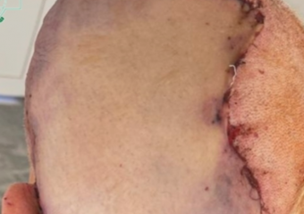 Ставропольские хирурги впервые в СКФО удалили гигантскую ангиому кожи головы 