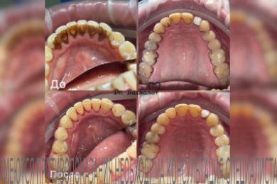 Стоматолог Денис Алексеевич Бажанов. Чистка зубов - 
