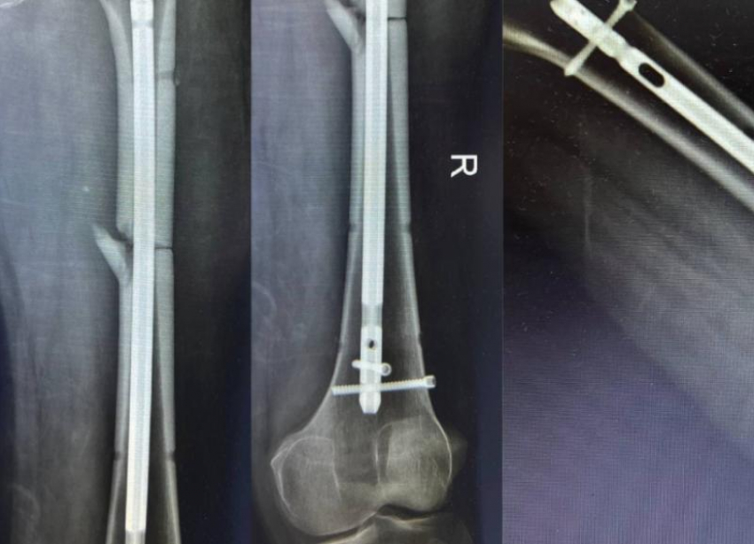 Чудо в Ставрополе: 55-летнего мужчину вернули к жизни после падения с семиметровой высоты