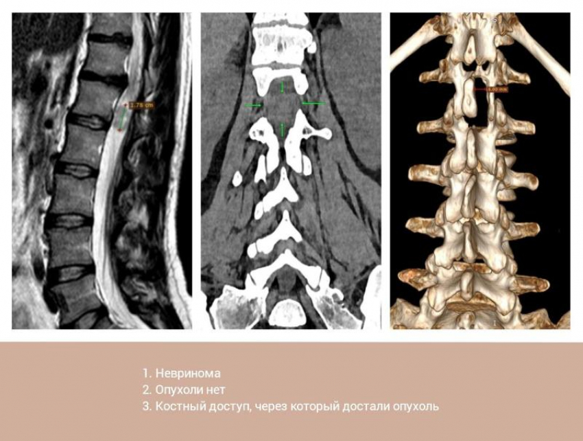 Опухоль из позвоночника через крошечный разрез удалили пациентке нейрохирурги Пятигорска