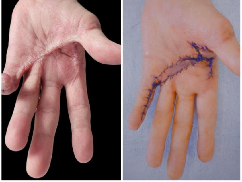 Хирурги Пятигорска вернули мужчине подвижность руки после страшной травмы на работе