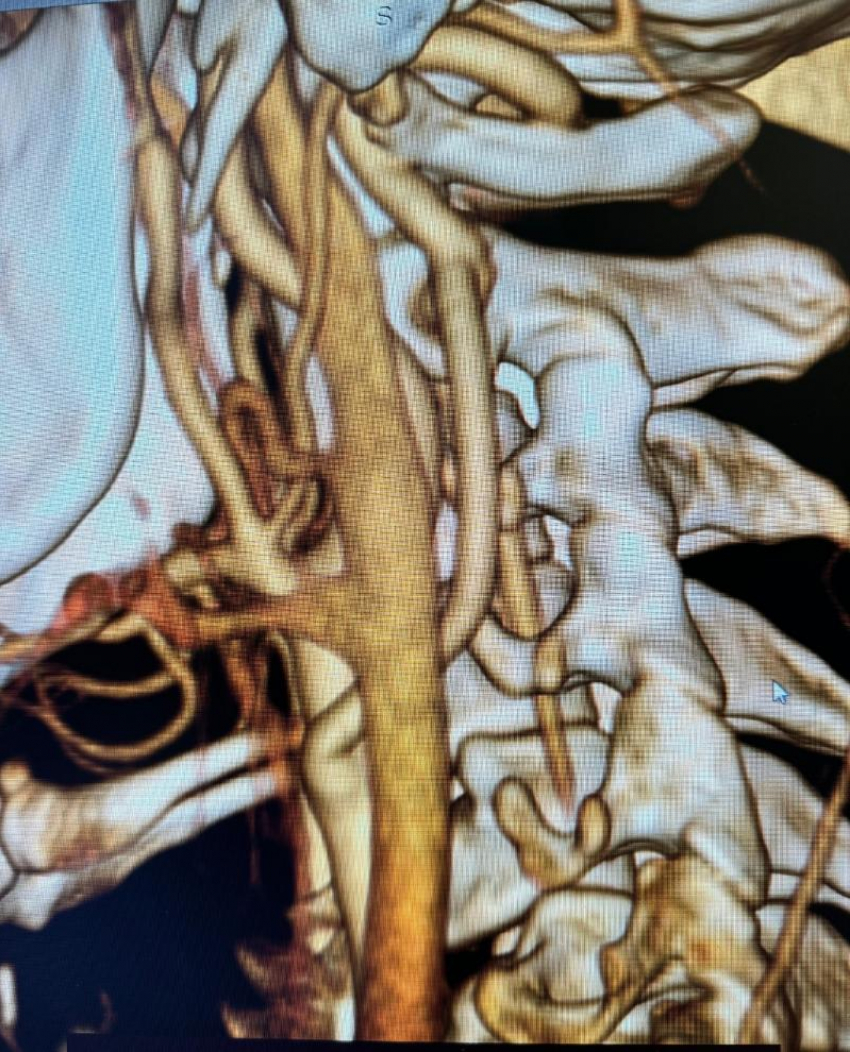 Хирурги провели уникальную по своей сложности операцию пациенту с непроходимостью позвоночной артерии