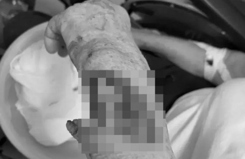 Порвала руку: 83-летняя ставропольчанка попала в больницу из-за скользкой лестницы 