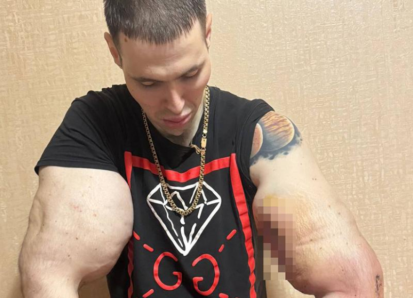 Блогер Руки Базуки из Пятигорска показал, как выглядит на 5 день после серьезной операции 