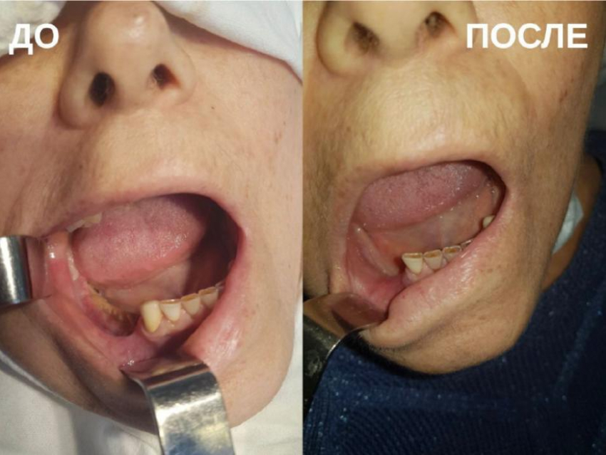 Врачи в Ставрополе вылечили остеонекроз челюсти у онкобольного