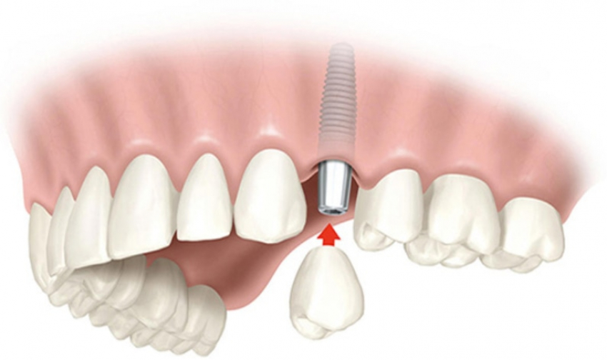 Имплантация зубов