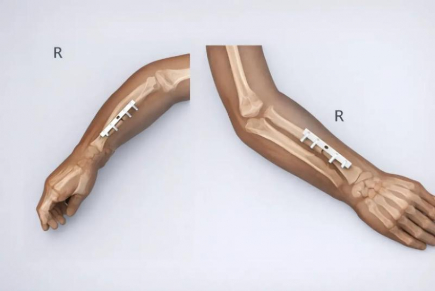 Редкая операция в Ставрополе: ребенку со сложной болезнью костей вернули подвижность руки