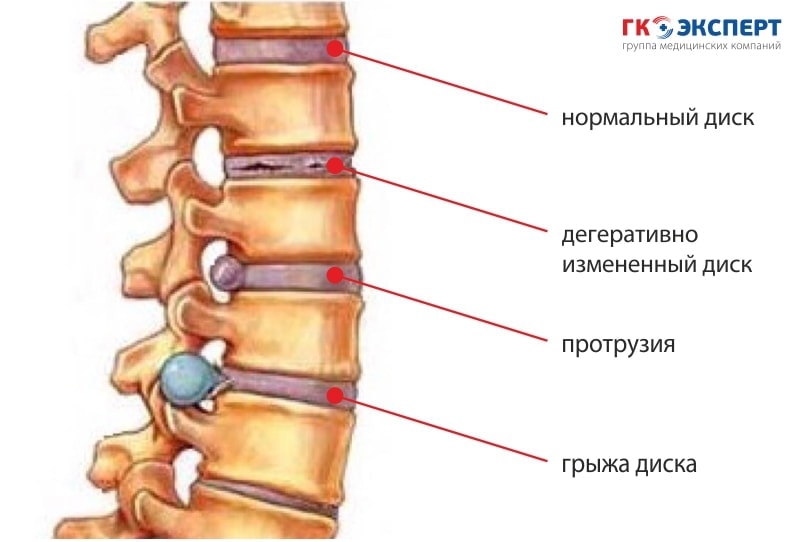 2 alt - протрузия и грыжа межпозвоночного диска-min.jpg